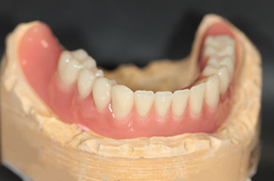 fertiggestelltes Implantat Totalprothese