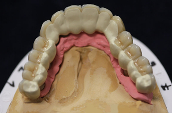 Zahnersatz metallfrei, PEEK Teleskope, Zirkon-Abutments