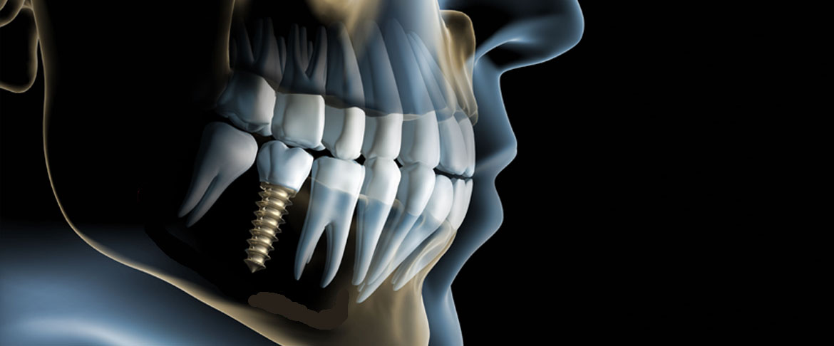 Implantate